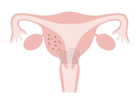 Téléchargez les illustrations : Illustration of adenomyosis of the uterus that occurred in a part of the uterus. Diseases of the uterus in women. - en licence libre de droit