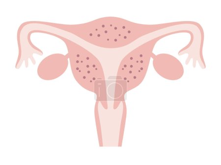 Illustration of adenomyosis that occurs throughout the uterus. Diseases of the uterus in women