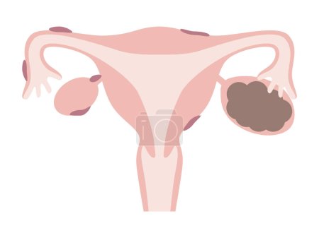 Illustration for Endometriosis and ovarian endometriosis.(chocolate cyst) Diseases of the uterus in women. - Royalty Free Image