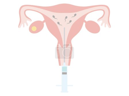 Illustration for Infertility treatment using artificial insemination. Illustration about pregnancy and childbirth. - Royalty Free Image