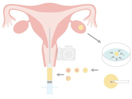 Illustration for Infertility treatment using in vitro fertilization. Illustration about pregnancy and childbirth - Royalty Free Image