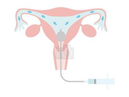 Illustration for Hysterosalpingography for fertility treatment. A state in which a contrast medium is placed in the uterus. Illustration about pregnancy and childbirth. - Royalty Free Image