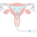 Hysterosalpingography for fertility treatment. A state in which a contrast medium is placed in the uterus. Illustration about pregnancy and childbirth.