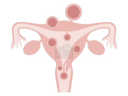 Illustration for Types of uterine fibroids.(Subserosal fibroids, intramuscular uterine fibroids and submucosal fibroids) Diseases of the uterus in women. - Royalty Free Image