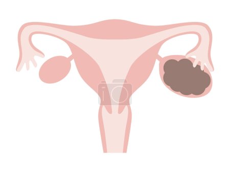 Illustration of ovarian endometriosis.(chocolate cyst) Diseases of the uterus in women.