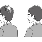 Before and after men with thin hair. Monochrome illustration. Young man in suit.