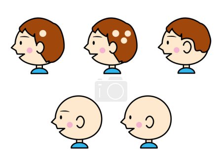 Téléchargez les illustrations : A cute profile illustration showing the type of alopecia. Medical illustration. - en licence libre de droit