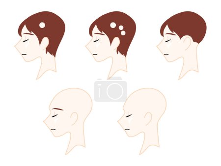 Téléchargez les illustrations : Profile of a neutral person representing the type of alopecia. Medical illustration. - en licence libre de droit