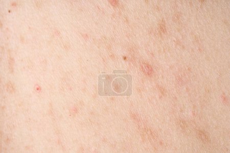 Photo for Skin with acne, with red spots. Health problem, skin diseases. Close up Allergy rash. Dermatitis problem of rash. - Royalty Free Image