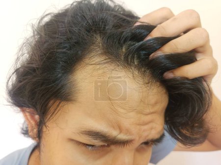 Téléchargez les photos : Choqué visage de l'homme asiatique devient chauve et perdu les cheveux dans fond blanc isolé - en image libre de droit