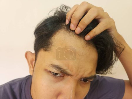 Photo for Shocked face of Asian man getting bald and lost hair in isolated white background - Royalty Free Image