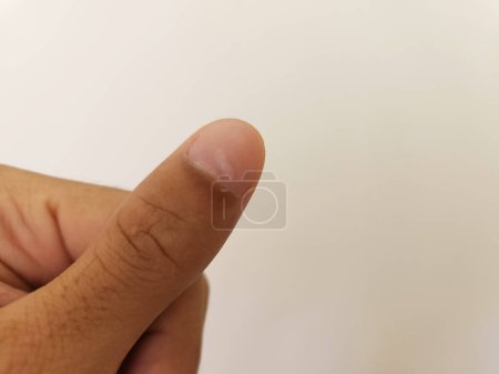 Photo for Close up white spot on finger nails called leukonychia, sickness concept - Royalty Free Image