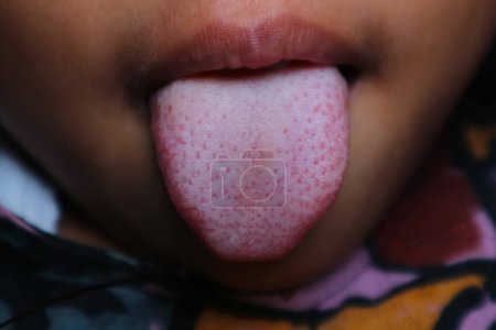 Kind asiatischer Mädchen leidet unter Zungenrausch