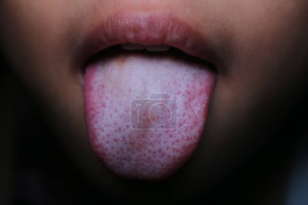 Child Asian girls suffering tongue trush