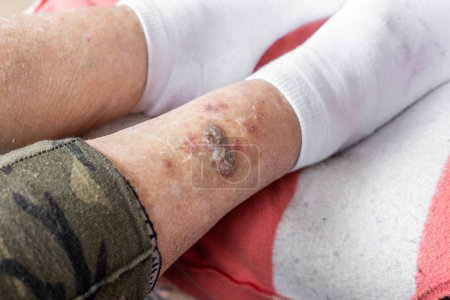 Ulcers and skin diseases, dried scabs and fresh wounds on the legs of an elderly woman, Health concept, senile changes, close up