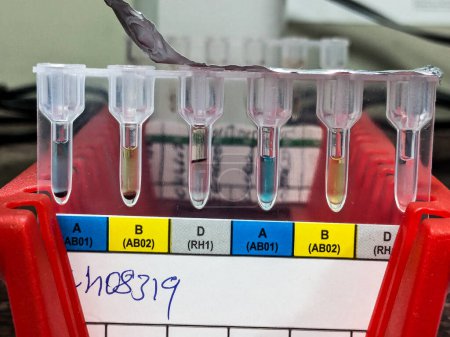 Método Gel Card de análisis de grupo sanguíneo en el laboratorio