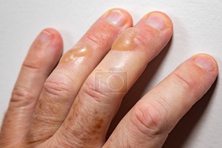 Typical blisters on the skin from second-degree burning by boiling oil. second degree burn