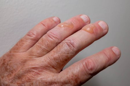 Photo for Typical blisters on the skin from second-degree burning by boiling oil. second degree burn - Royalty Free Image