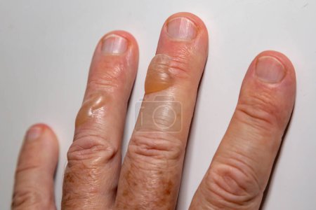 Photo for Typical blisters on the skin from second-degree burning by boiling oil. second degree burn - Royalty Free Image