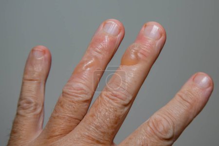 Photo for Typical skin blisters from second-degree boiling oil burns. - Royalty Free Image