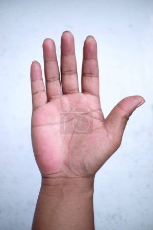 Photo for Asian adult male right hand showing the simian line on the palm - Royalty Free Image