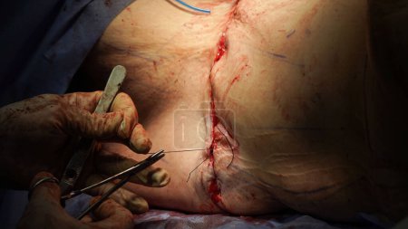 Photo for Tummy tuck surgery. Doctor performs tummy tuck surgery with cautery - Royalty Free Image