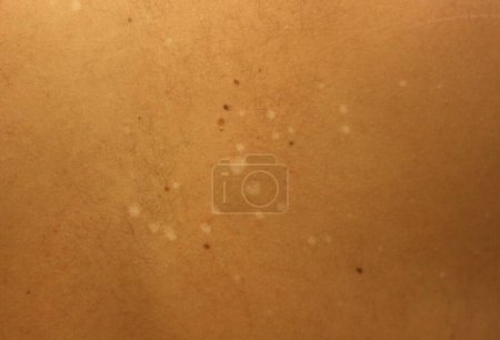 An unsettling close-up shot reveals the presence of white spots caused by skin fungus, highlighting the discomfort and concern associated with fungal infections