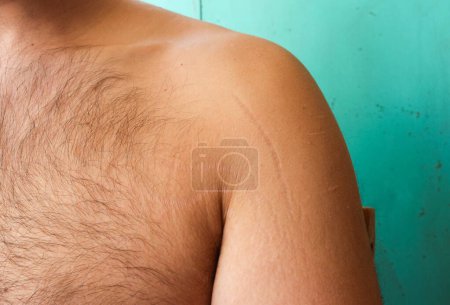 self-acceptance and care as you explore the topic of stretch marks on a man's arms and chest