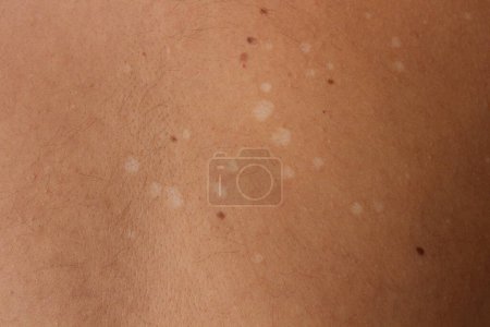 Explorez les nuances de Tinea Versicolor, également connu sous le nom de pityriasis versicolor, une infection fongique commune affectant la peau