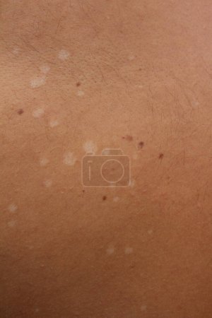 Entdecken Sie die Nuancen von Tinea Versicolor, auch bekannt als Pityriasis versicolor, einer häufigen Pilzinfektion der Haut