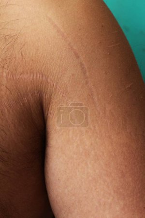 self-acceptance and care as you explore the topic of stretch marks on a man's arms and chest