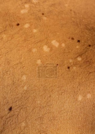 Erfassen Sie die visuelle Komplexität von Tinea versicolor, einer häufigen Pilzinfektion der Haut, mit diesem hochauflösenden Archivbild