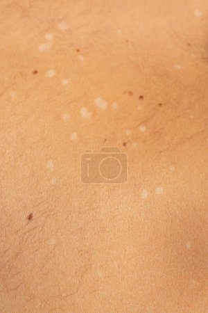 Capture the visual complexity of tinea versicolor, a common fungal skin infection, with this high-resolution stock image