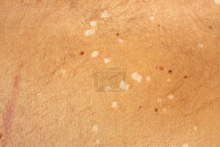 Capture the visual complexity of tinea versicolor, a common fungal skin infection, with this high-resolution stock image