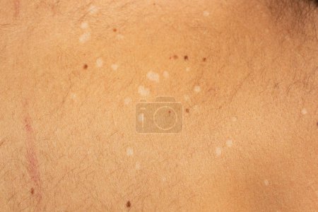 Capturez la complexité visuelle de tinea versicolor, une infection fongique commune de la peau, avec cette image haute résolution