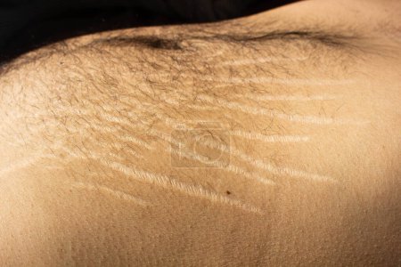 Photo for Explore the impact of weight changes, including obesity and muscle gain, on the male body through this compelling stock image capturing stretch marks - Royalty Free Image