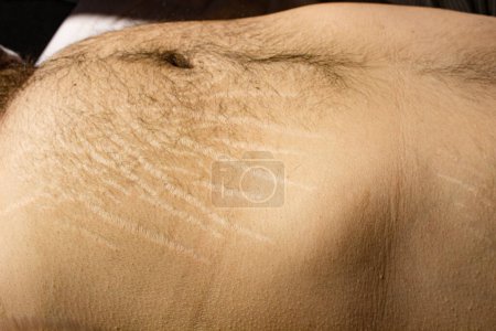 Explore the impact of weight changes, including obesity and muscle gain, on the male body through this compelling stock image capturing stretch marks