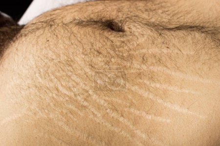 Photo for Explore the impact of weight changes, including obesity and muscle gain, on the male body through this compelling stock image capturing stretch marks - Royalty Free Image