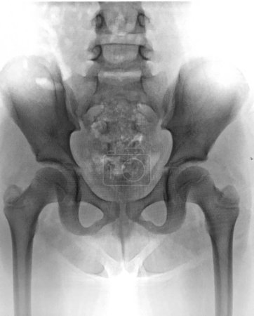 Photo for Film x-ray pelvis and both hip - Royalty Free Image