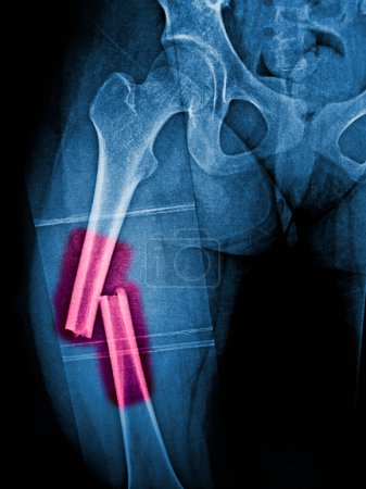 Photo for X-ray femur show complete fracture shaft of femur and displace - Royalty Free Image
