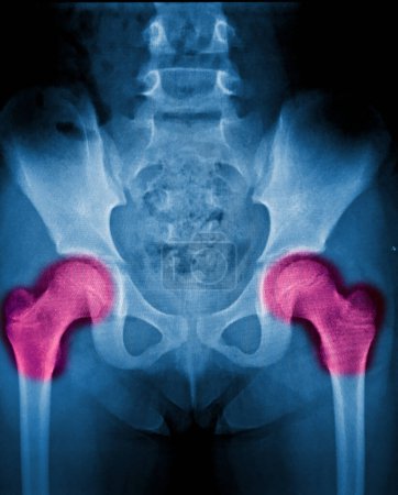 Photo for X-ray image of male pelvis and neck of femur - Royalty Free Image