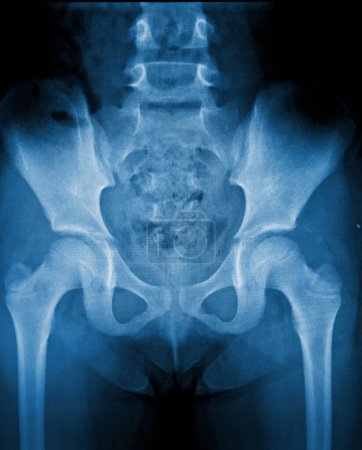 Photo for X-ray image of male pelvis and neck of femur - Royalty Free Image