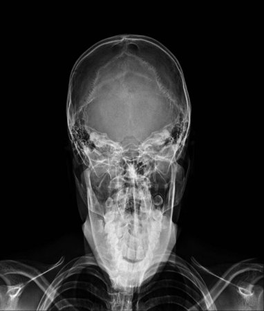 Foto de X-ray AP towns skull view - Imagen libre de derechos