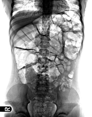 Photo for Abdomen, Distended, Flatulence, X ray abdomen - Royalty Free Image