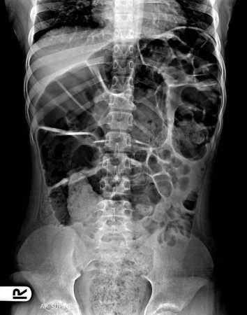 Foto de Abdomen, Distended, Flatulence, X ray abdomen - Imagen libre de derechos