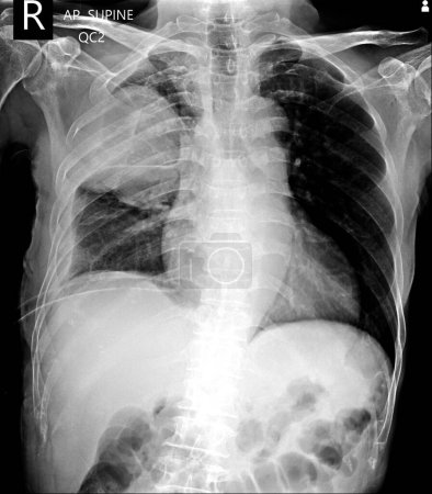 Téléchargez les photos : Pneumothorax on ICD. chest x ray AP supine - en image libre de droit