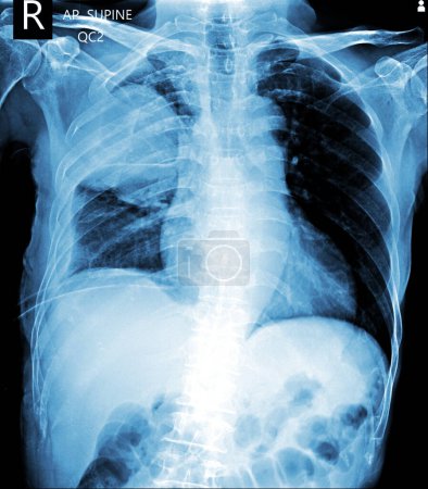 Téléchargez les photos : Pneumothorax on ICD. chest x ray AP supine - en image libre de droit
