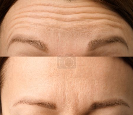 Foto de Arrugas de cerca. Tratamientos faciales. Programa anti-envejecimiento, concepto. Eliminación de arrugas, cambios relacionados con la edad. Cosmetología, inyecciones, mesoterapia. - Imagen libre de derechos