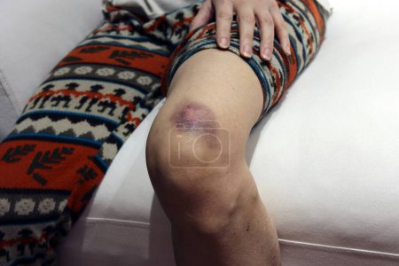Photo for Bruises on skin of her leg - Royalty Free Image