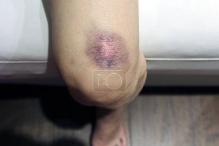 Photo for Bruises on skin of her leg - Royalty Free Image